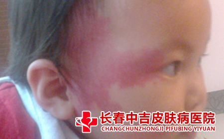 需要接受专门治疗的胎记