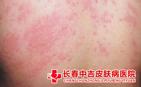 怎么能更合适的治疗皮炎