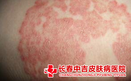 怎样治疗湿疹比较有效