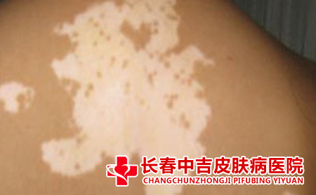 白癜风的常识有哪些
