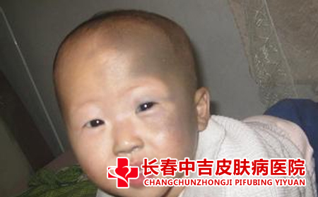 祛胎记手术后能吃辣吗
