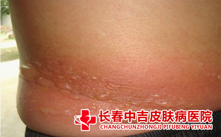 手上起小水泡是疱疹吗