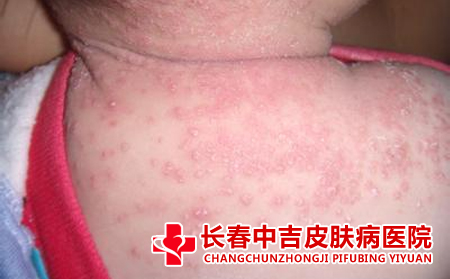 花粉会引起湿疹吗