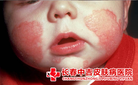 湿疹怎么护理