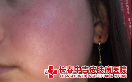 更合适的治疗红血丝要怎么做