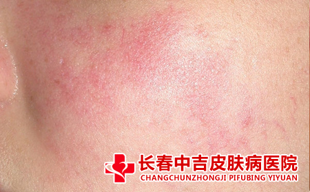 潮红和红血丝的区别