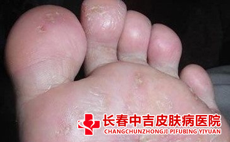 足癣