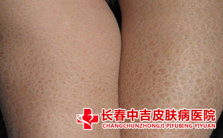 鱼鳞病