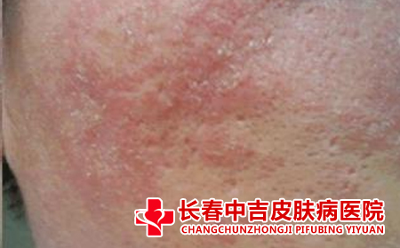 皮炎的防治