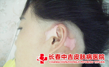 白癜风患者要怎么晒太阳