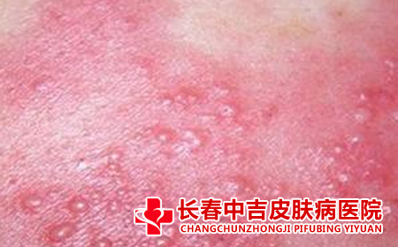 怎么预防湿疹再出现
