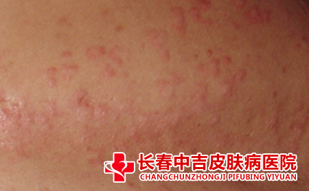 荨麻疹治疗