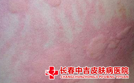 划痕性荨麻疹
