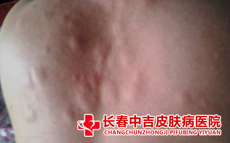 荨麻疹复发