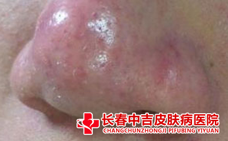 酒糟鼻危害