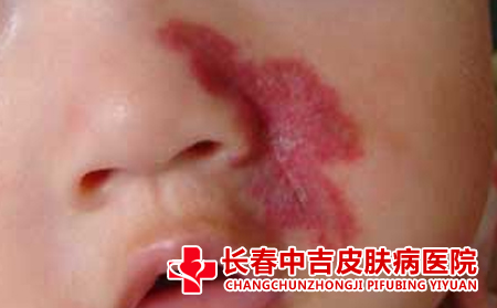 鲜红斑痣并发症