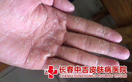 手足癣预防