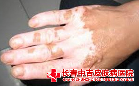 局限性白癜风危害