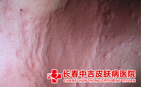 荨麻疹诊断标准