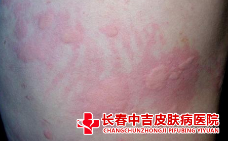 荨麻疹对我们的生活会产生什么样的影响