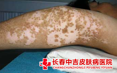 白癜风发病的原因是什么