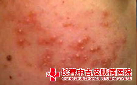 导致痤疮的原因是什么