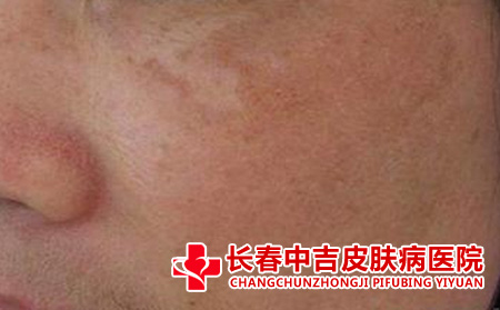 黄褐斑都有什么样的症状