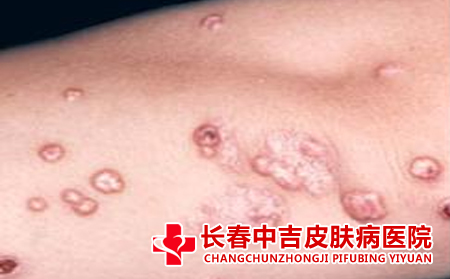 扁平疣在平时应该注意什么