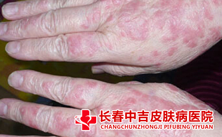皮炎患者应该怎么注意护理、