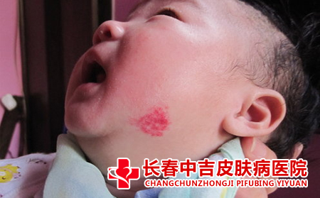 胎记对于患者的危害有什么