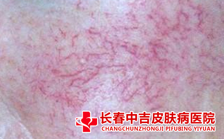 激光去除红血丝