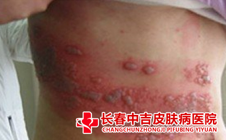 带状疱疹应该怎么进行治疗