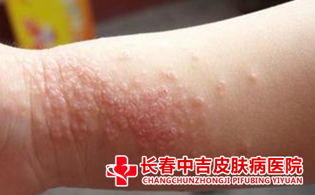 患者怎么预防皮炎的复发