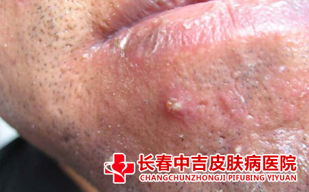毛囊炎合适治吗