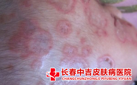 红斑狼疮的症状