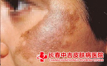 黄褐斑的危害是什么