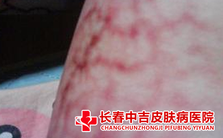  红血丝的激光治疗法