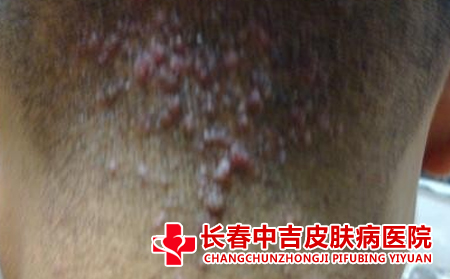 毛囊炎与肌肤干燥的关系