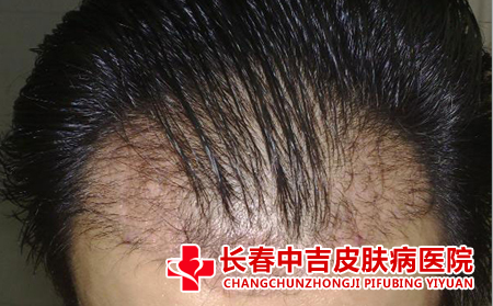 什么因素导致脂溢性脱发