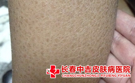  孩子受到鱼鳞病的影响吗