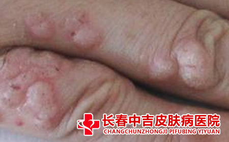 扁平庞如何治疗
