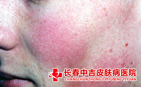 面部红血丝形成的原因