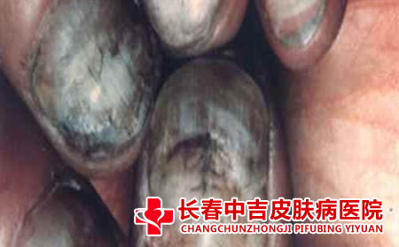 灰指甲前期症状