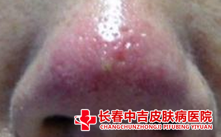 中医方面判断酒槽鼻成因