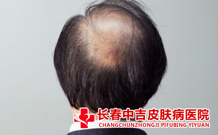 生姜治疗脱发是否管用