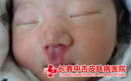 宝宝的成长受到胎毒的影响