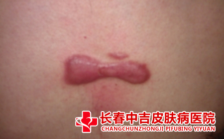 瘢痕体质的特征