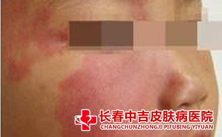 如何治疗红斑狼疮