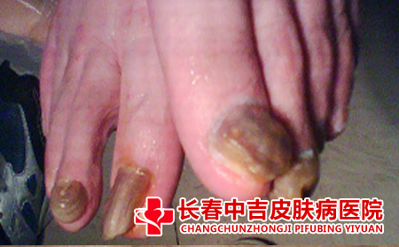 治疗灰指甲用什么药