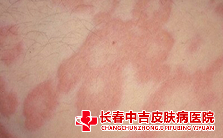 治疗急性皮炎的措施 治疗变态性皮炎的不错方法有哪些呢?一般需要经过寻找病因、去除病